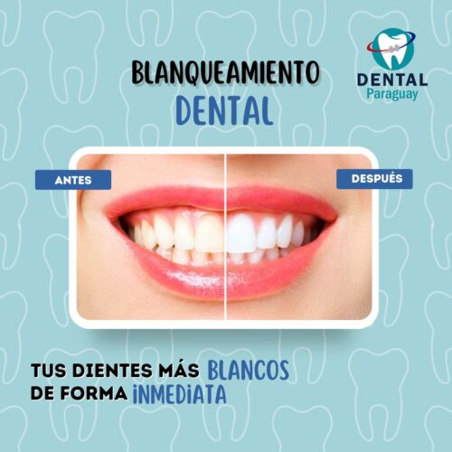 BLANQUEAMIENTO EN CONSULTORIO