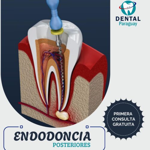 ENDODONCIA EN DIENTES POSTERIORES